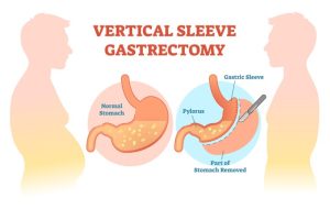 Sleeve after gastric before surgery natalie testimonial had life